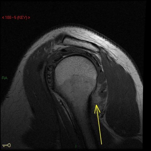Figure 5 for case Posterior dislocation, posterior capsular avulsion from humerus   teres minor tear